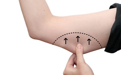 Best Liposuction in Beverly Hills